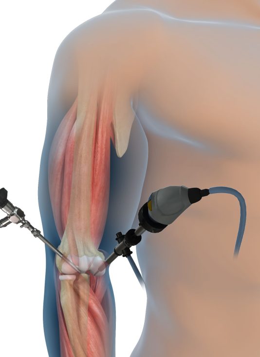 Elbow_Arthroscopy