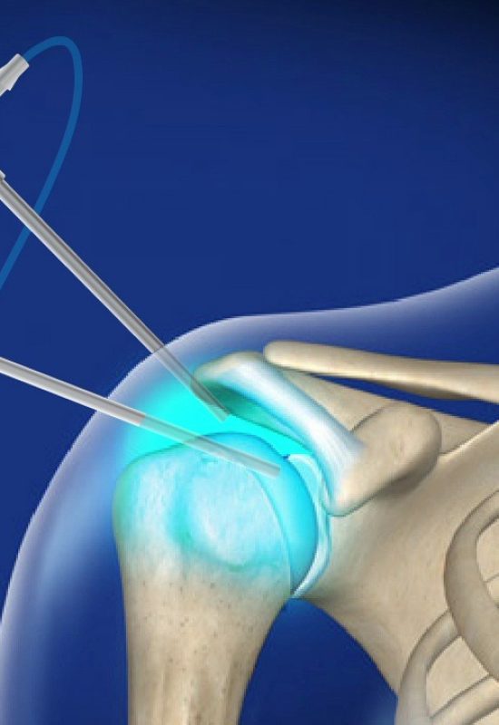 shoulder_arthroscopy (1)